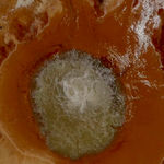 Liu Xin, teratoma, 2019