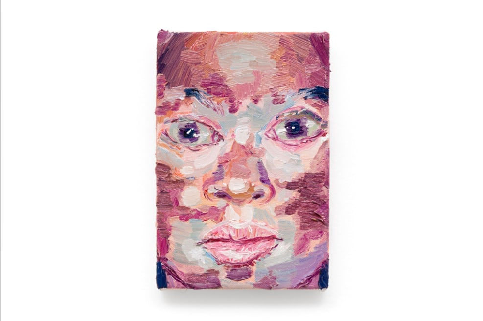 Thiago Martins de Melo, Vitiligo, 2016