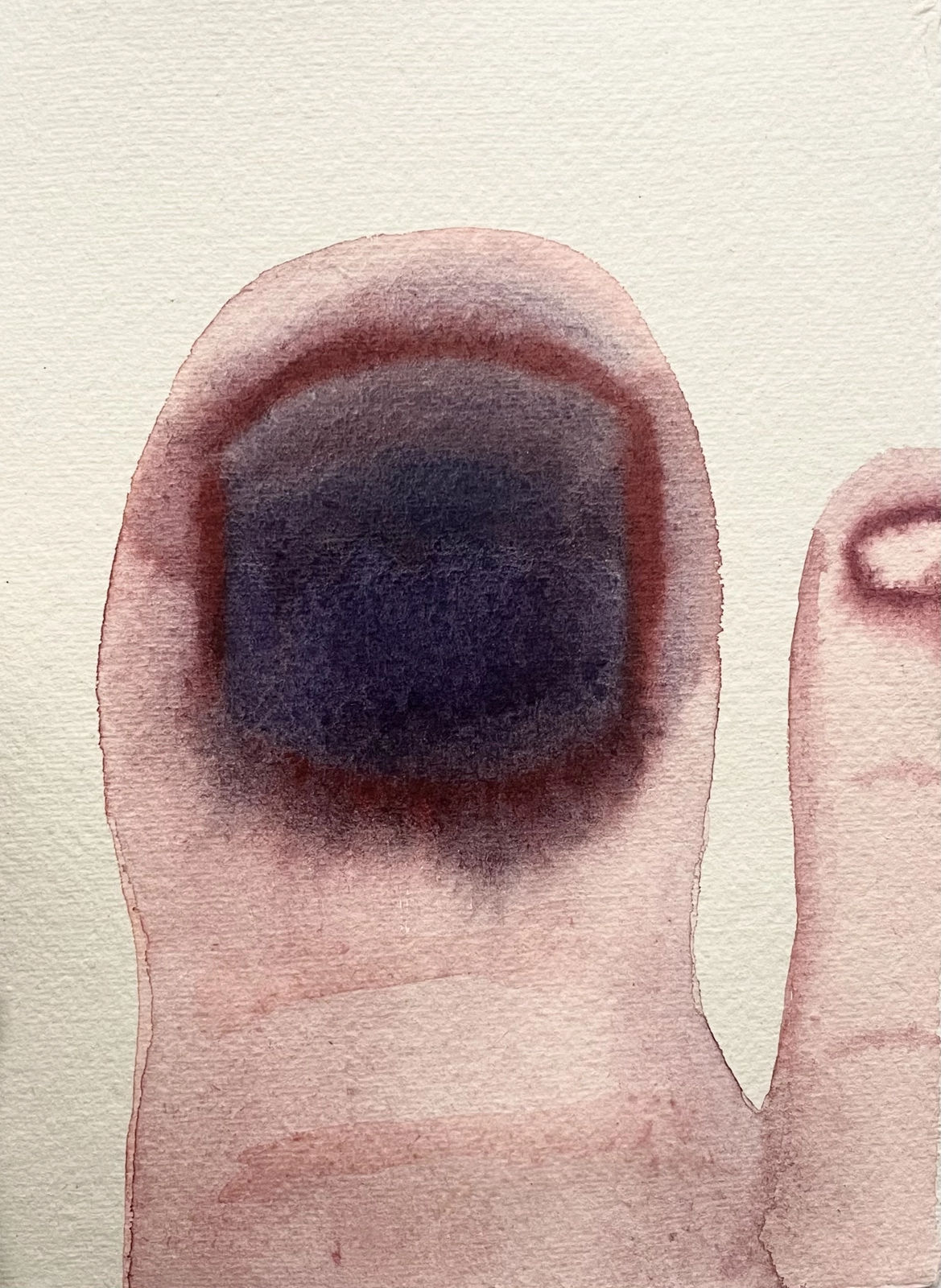 Polly Burnay, Footballer's Toe