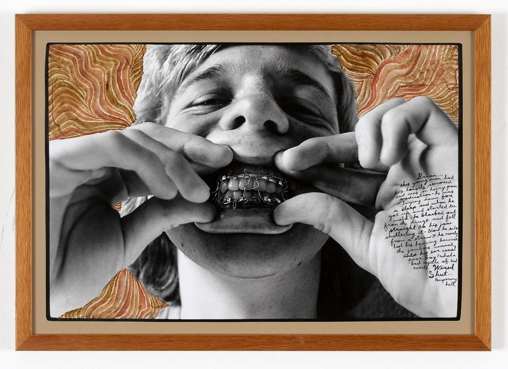 Ed Templeton, Kid w/wired shut jaw!