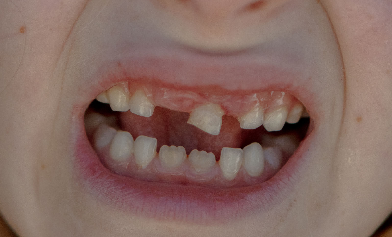 Emily Peacock, Baby Tooth, 2025