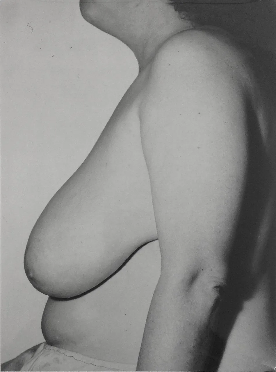 Jo Spence, Remodelling Photo History (Regulation), 1982