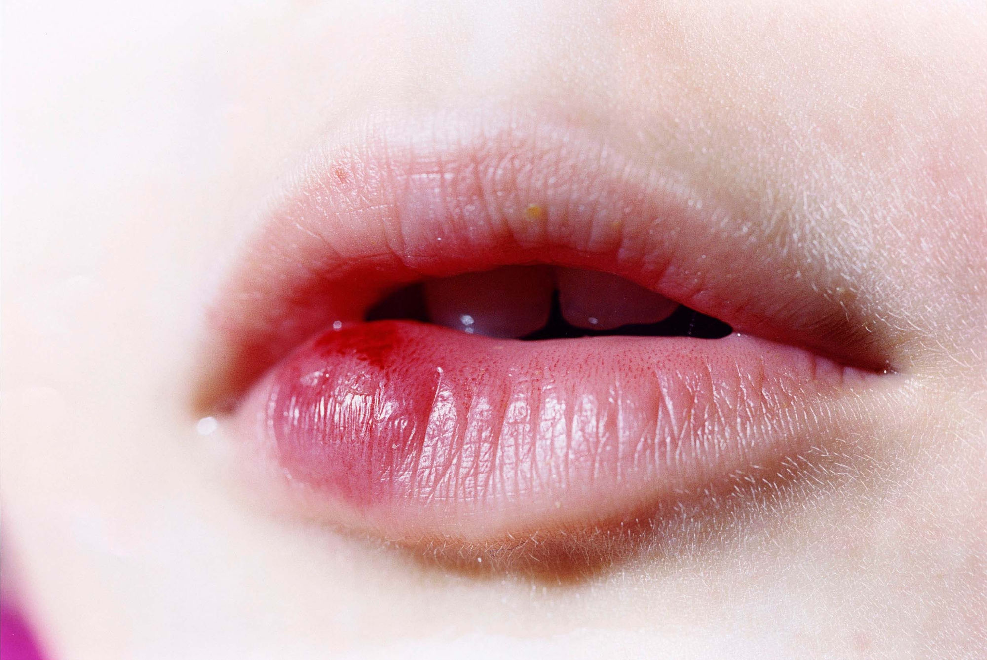 Elinor Carucci, Bruised mouth, 2007
