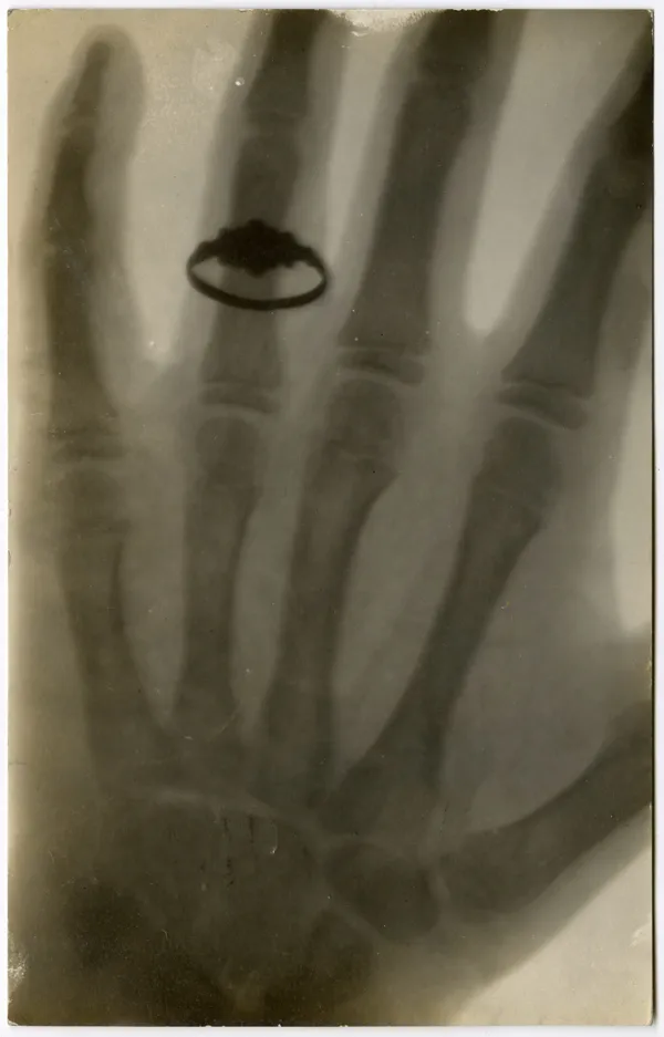Unknown, X-Ray Photo Postcard of a Ringed Finger, Peru, NE, 1911