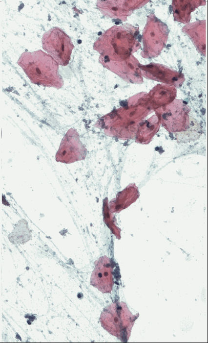 Matthieu Graffensttaden, Oeuvre 3 Tirage Fine Art Encadrement Plexiglas Cytologie Coloration Papanicolaou